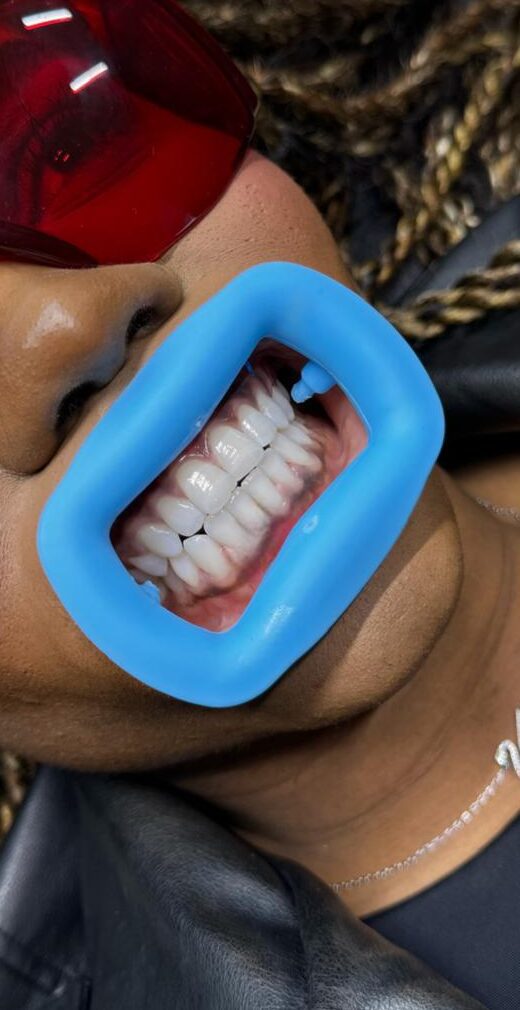 Blanchiment dentaire professionnel chez Glamcia Beauty